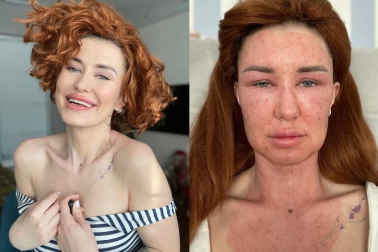 Бьюти-блогер испугала подписчиков и привлекла хейтеров, показав лицо после процедуры