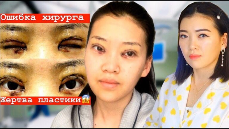 Меня изуродовал хирург😭Повторная пластическая операция в Корее😢Слабонервным не смотреть|NikyMacAleen