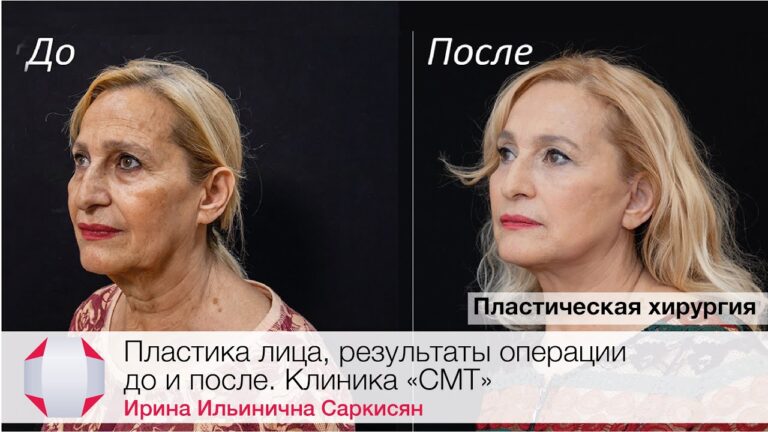 Пластика лица, результаты операции до и после. Клиника "СМТ", пластический хирург Саркисян И.И.