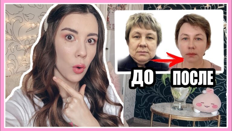 МОЯ ПЛАСТИЧЕСКАЯ ОПЕРАЦИЯ В КОРЕЕ 🤒🏩 ВО ВРЕМЯ И ПОСЛЕ ОПЕРАЦИИ 🇰🇷 СЕУЛ