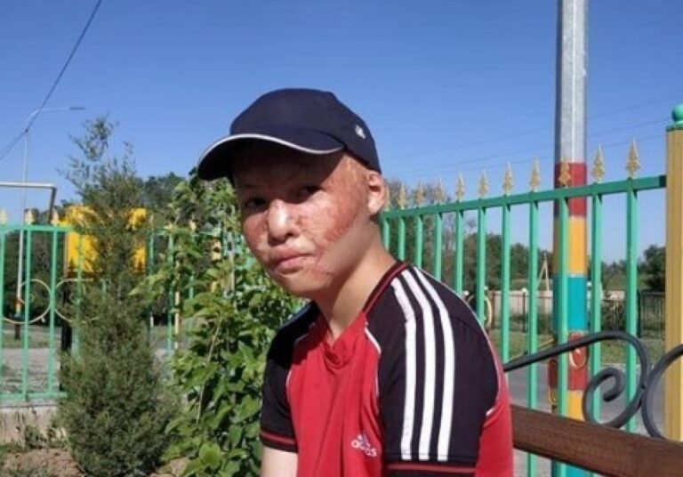 Подростку из Шымкента пересадили часть кожи в Израиле ─ NewTimes.kz Подростку из Шымкента пересадили часть кожи в Израиле ─ NewTimes.kz
