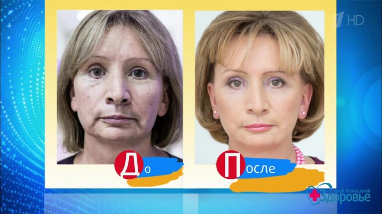 Здоровье. Круговая подтяжка лица. Красота с командой доктора Пухова.  (21.01.2018)