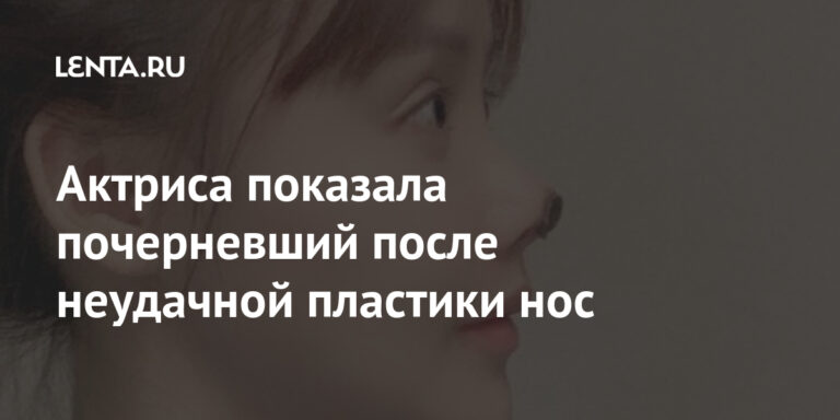 Актриса показала почерневший после неудачной пластики нос: Внешний вид: Ценности: Lenta.ru Актриса показала почерневший после неудачной пластики нос: Внешний вид: Ценности: Lenta.ru