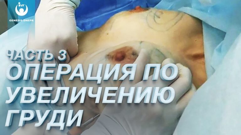 Операция по увеличению груди у Сергей Хаустов. Пластическая хирургия в Клинике GENESIS DNEPR Часть 3