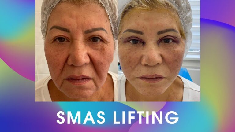 Операционный smas лифтинг. Подтяжка лица. Блефаропластика