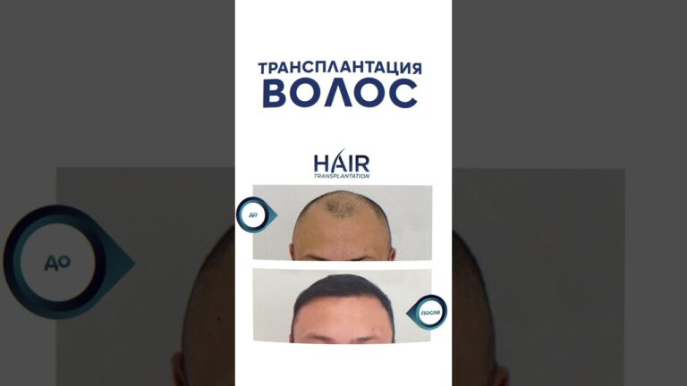 Трансплантация волос. До и После