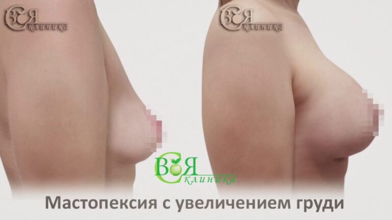 Мастопексия / увеличение груди / Своя клиника / пластическая хирургия / Санкт-Петербург