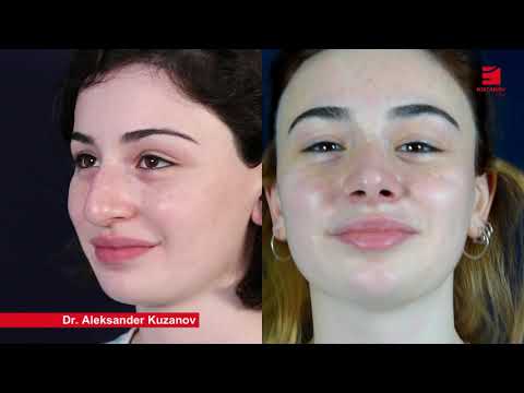 სტრუქტურული ულტრაბგერითი სეპტორინოპლასტიკა!
