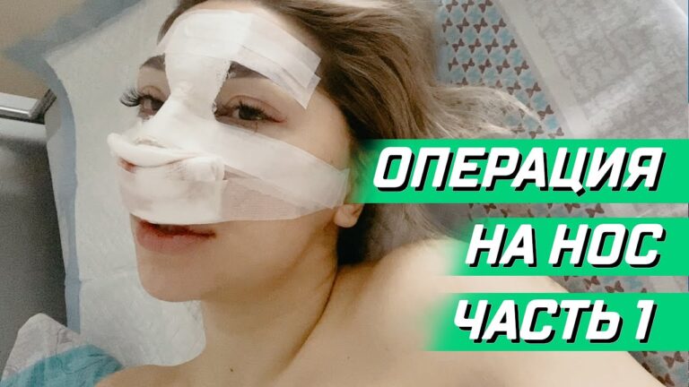 Операция на нос. Ринопластика методом пьезохирургии. Пластическая хирургия носа. Мой опыт часть 1