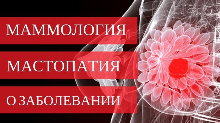 МАСТОПАТИЯ молочных желез — о заболевании