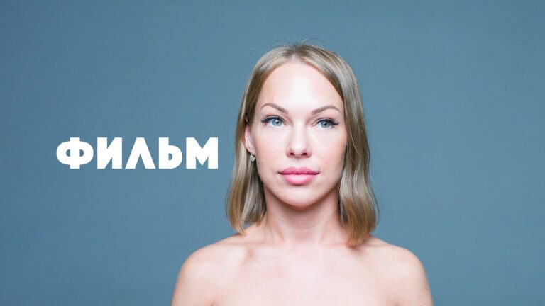 Нижняя блефаропластика и эндоскопическая подтяжка лба — до и после — история пациента — Юрий Цой