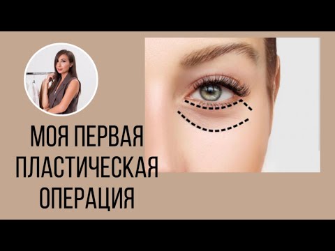 МОЯ ПЕРВАЯ ПЛАСТИЧЕСКАЯ ОПЕРАЦИЯ / БЛЕФАРОПЛАСТИКА