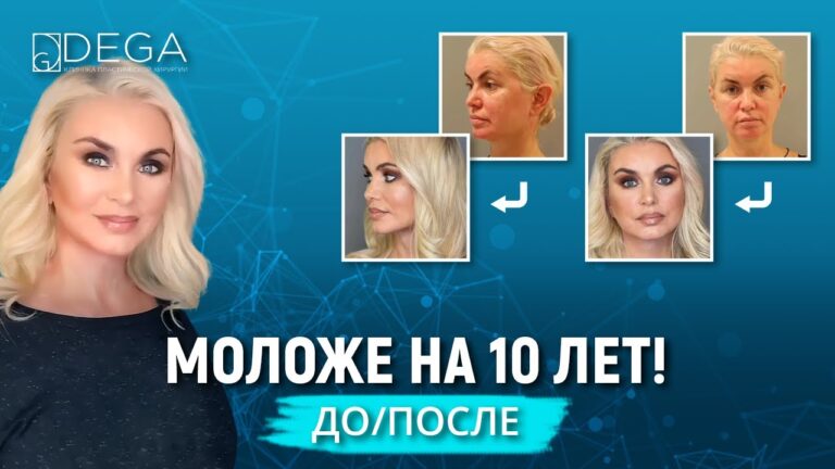 Потрясающее преображение от пластического хирурга клиники DEGA Антона Игоревича Выходцева!