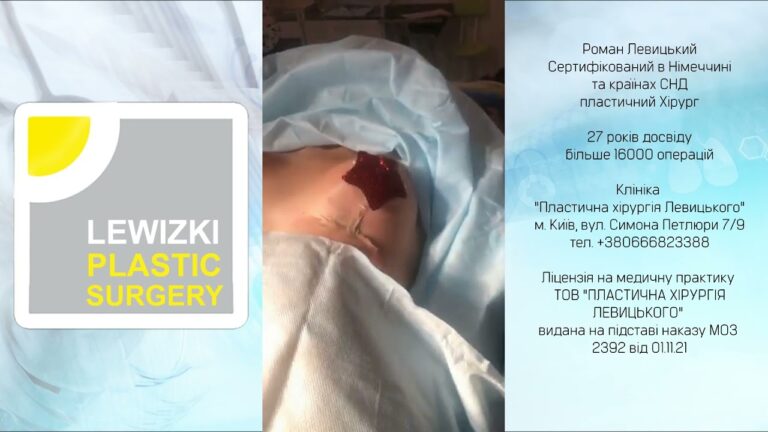 Підтяжка молочних залоз І Розрив імпланту