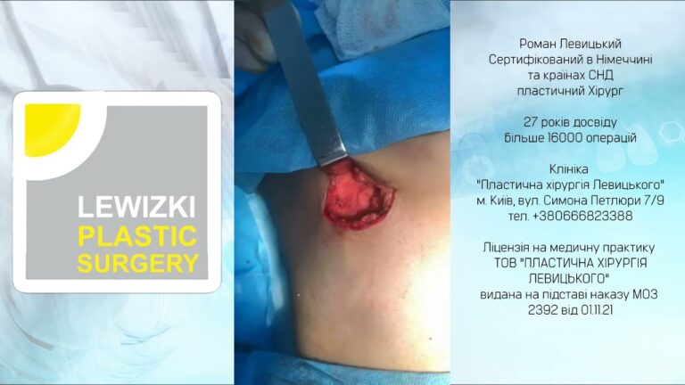 Пластический хирург Роман Миронович Левицкий: двойная капсула І Эндопротезирование молочных желез