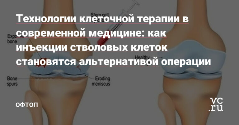 как инъекции стволовых клеток становятся альтернативой операции — Офтоп на vc.ru