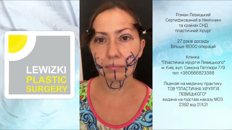 Подтяжка лица — подготовка к операции І Центр пластической хирургии г. Киев