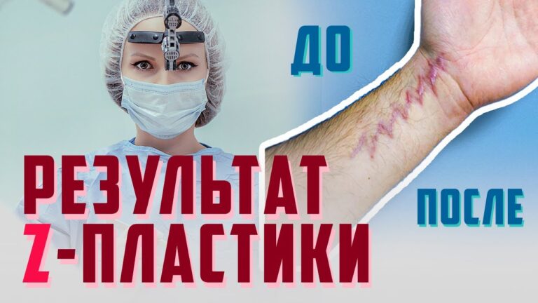 Гипертрофический рубец и пластическая хирургия | Результат z-пластики