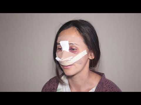 Ринопластика | Пластическая хирургия своими глазами. Выпуск 14