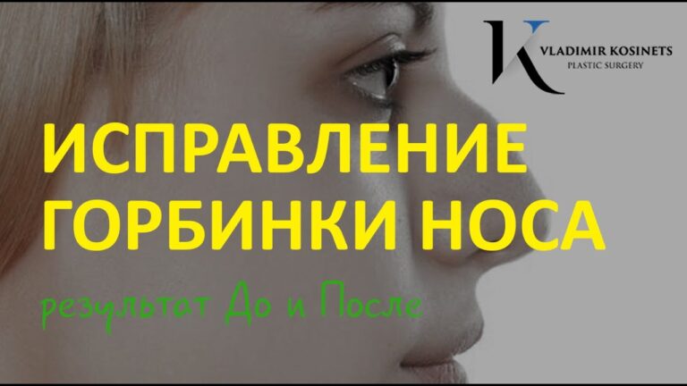 Ринопластика — Исправление горбинки носа, длинного кончика носа — хирург Владимир Косинец