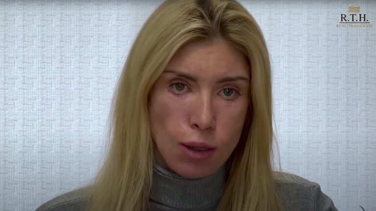 История Юлии Тарасевич. Возвращаем красоту жертве неудачной пластической операции.
