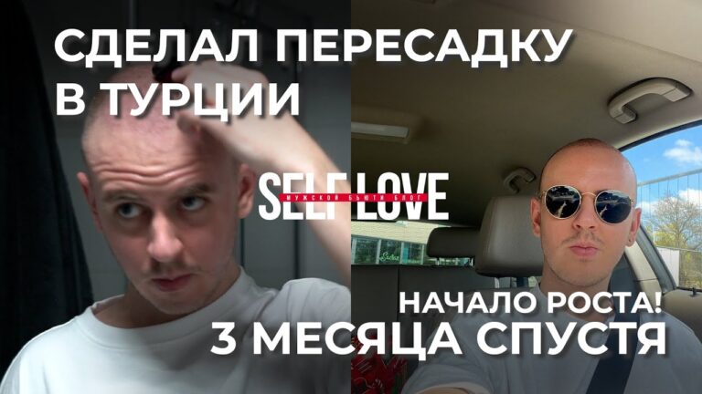 ВЛОГ 4 — Пересадка волос в Турции, отчет 3 месяца, Брекеты, Миноксидил
