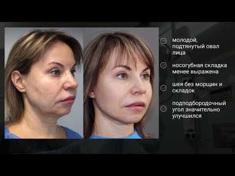фейслифтинг до-после