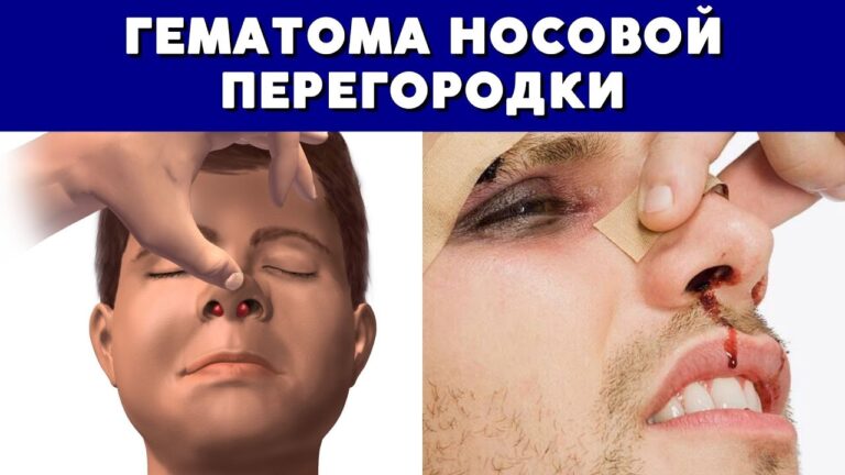 Гематома носовой перегородки