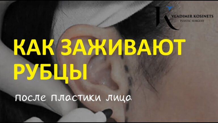 Как заживают рубцы после подтяжки лица — хирург Владимир Косинец