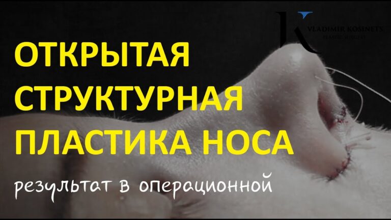 Открытая структурная ринопластика — хирург Владимир Косинец
