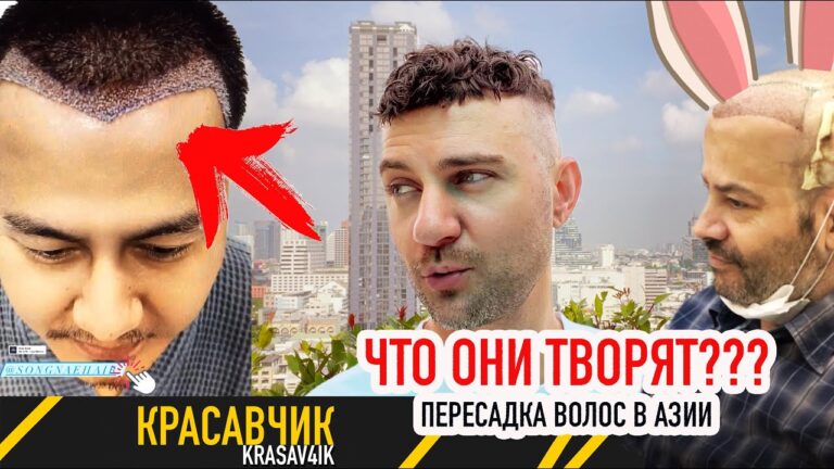 Ого! Что они там творят? Пересадка волос в Азии  Красавчик #пересадкаволос
