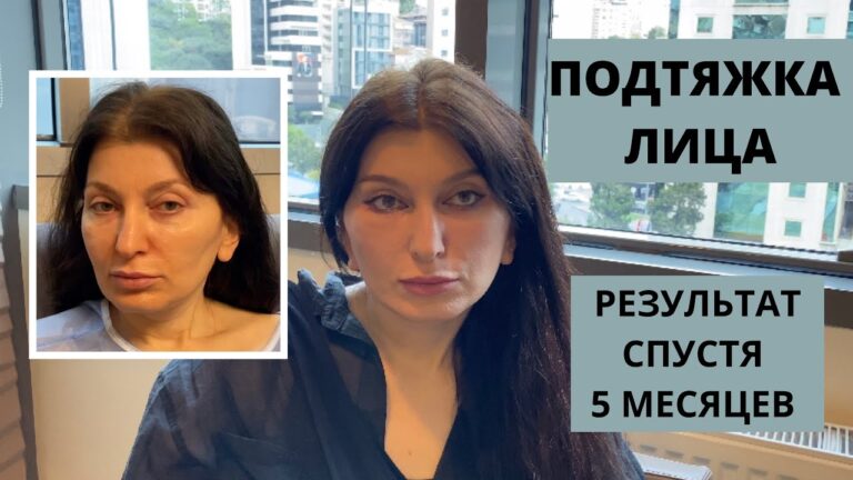 Круговая ПОДТЯЖКА ЛИЦА. Результат ДО и ПОСЛЕ. Стамбул.